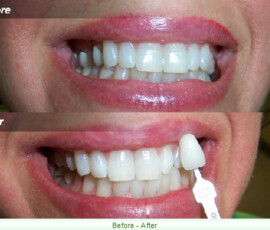A before and after picture of teeth whitening.