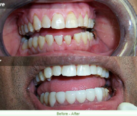 A before and after picture of teeth with yellow spots.