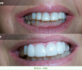 A before and after picture of teeth whitening.