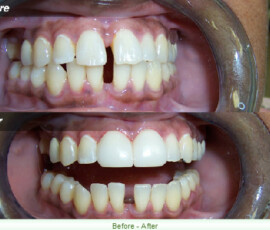 A before and after picture of the teeth whitening process.