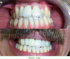 A man 's teeth before and after whitening.