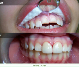 A before and after picture of the teeth with braces.