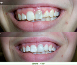 A before and after picture of the teeth whitening process.