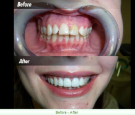 A woman 's teeth before and after dental treatment.