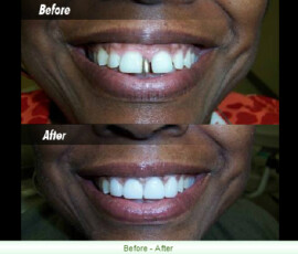 A man with missing teeth and before and after photos.