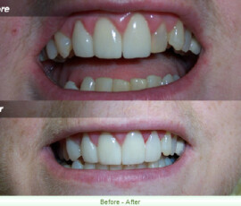 A before and after picture of the teeth whitening process.