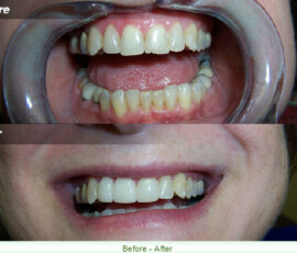 A before and after picture of the teeth whitening process.
