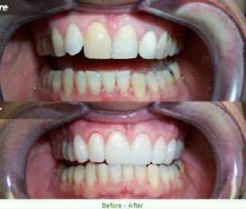 A before and after picture of teeth whitening