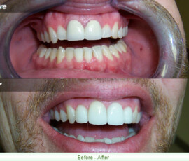 A before and after picture of the teeth whitening process.