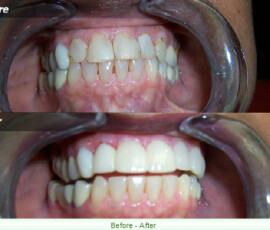 A before and after picture of teeth whitening