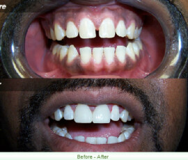 A before and after picture of teeth whitening.