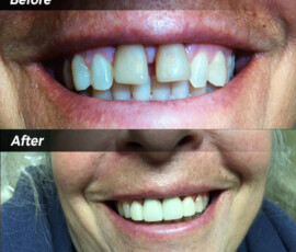A woman 's teeth before and after she has her smile restored.