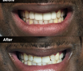 A before and after picture of teeth whitening.