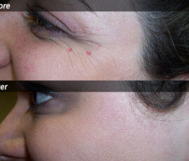 A woman with a red dot on her face and under eye.