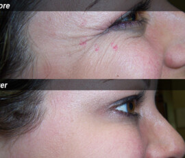 A woman with wrinkles on her face and under eye.